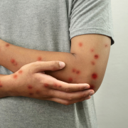 Caso suspeito de Mpox em Rio Branco acende alerta para prevenção e informação de qualidade