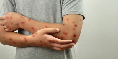 Caso suspeito de Mpox em Rio Branco acende alerta para prevenção e informação de qualidade