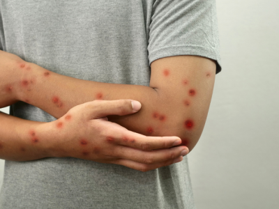 Caso suspeito de Mpox em Rio Branco acende alerta para prevenção e informação de qualidade